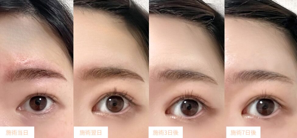 アートメイクのダウンタイムの経過